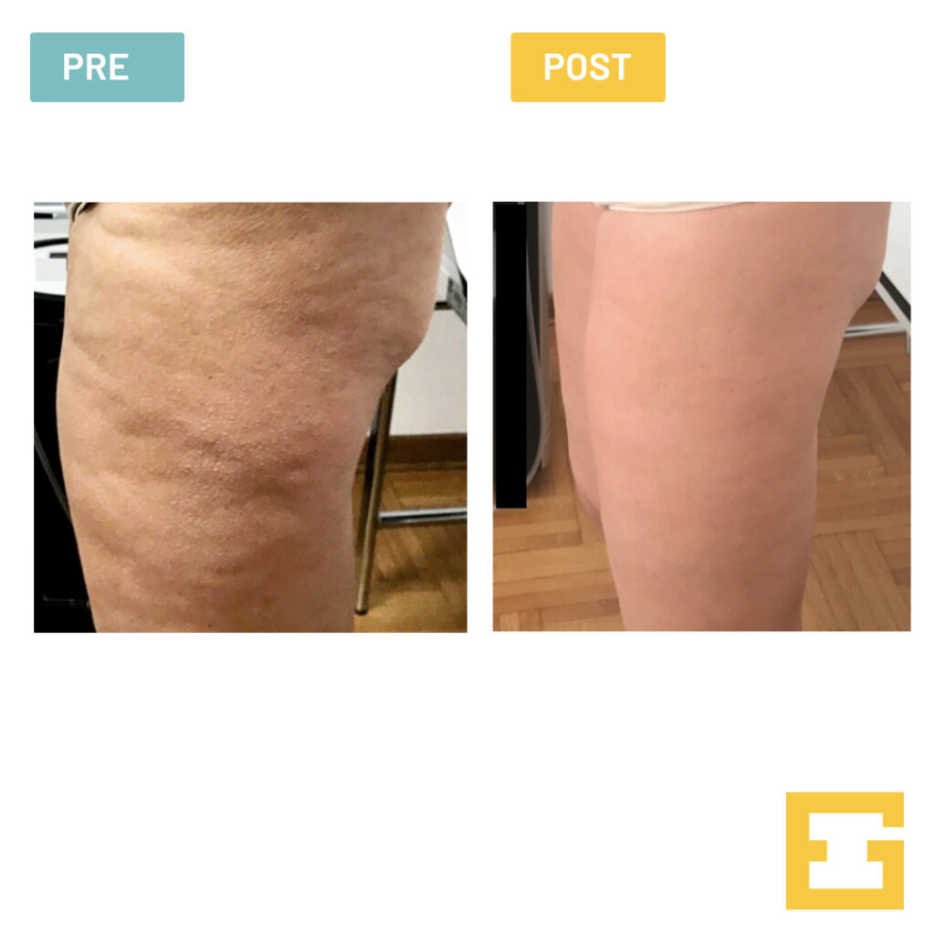 liposuzione-gambe